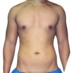 Vaser Liposuction
