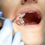 tooth extraction