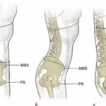 ASIS and Pelvic Alignment