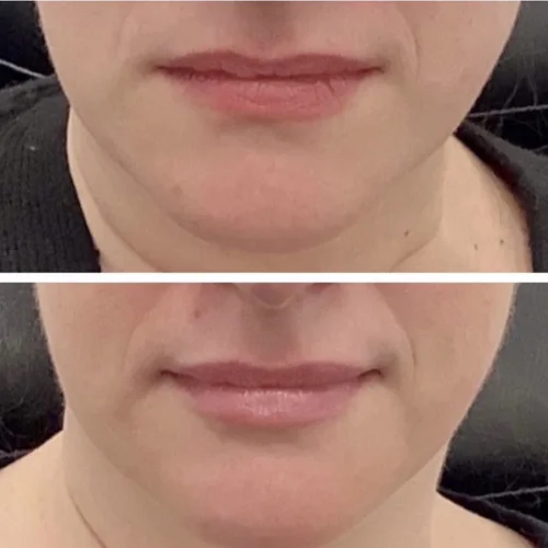 Best treatment for undereyes Chicago