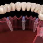 What Is the Procedure for Getting Dental Implants in Pearland?