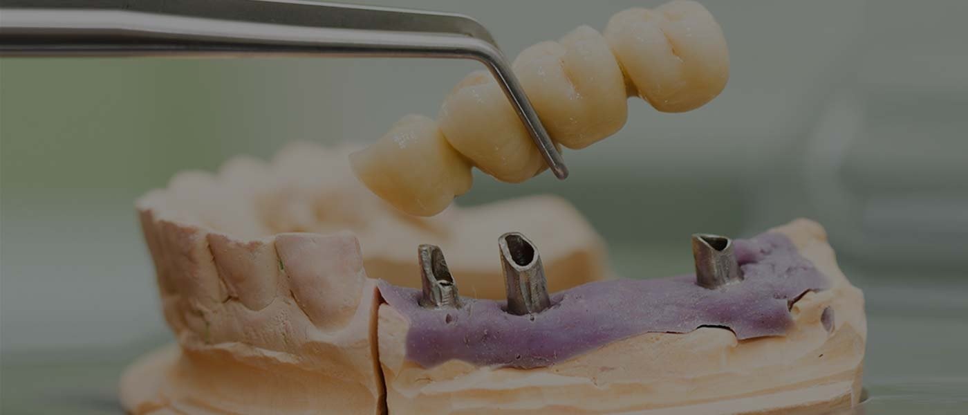 dental implant bridge