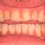 same day root canal near me