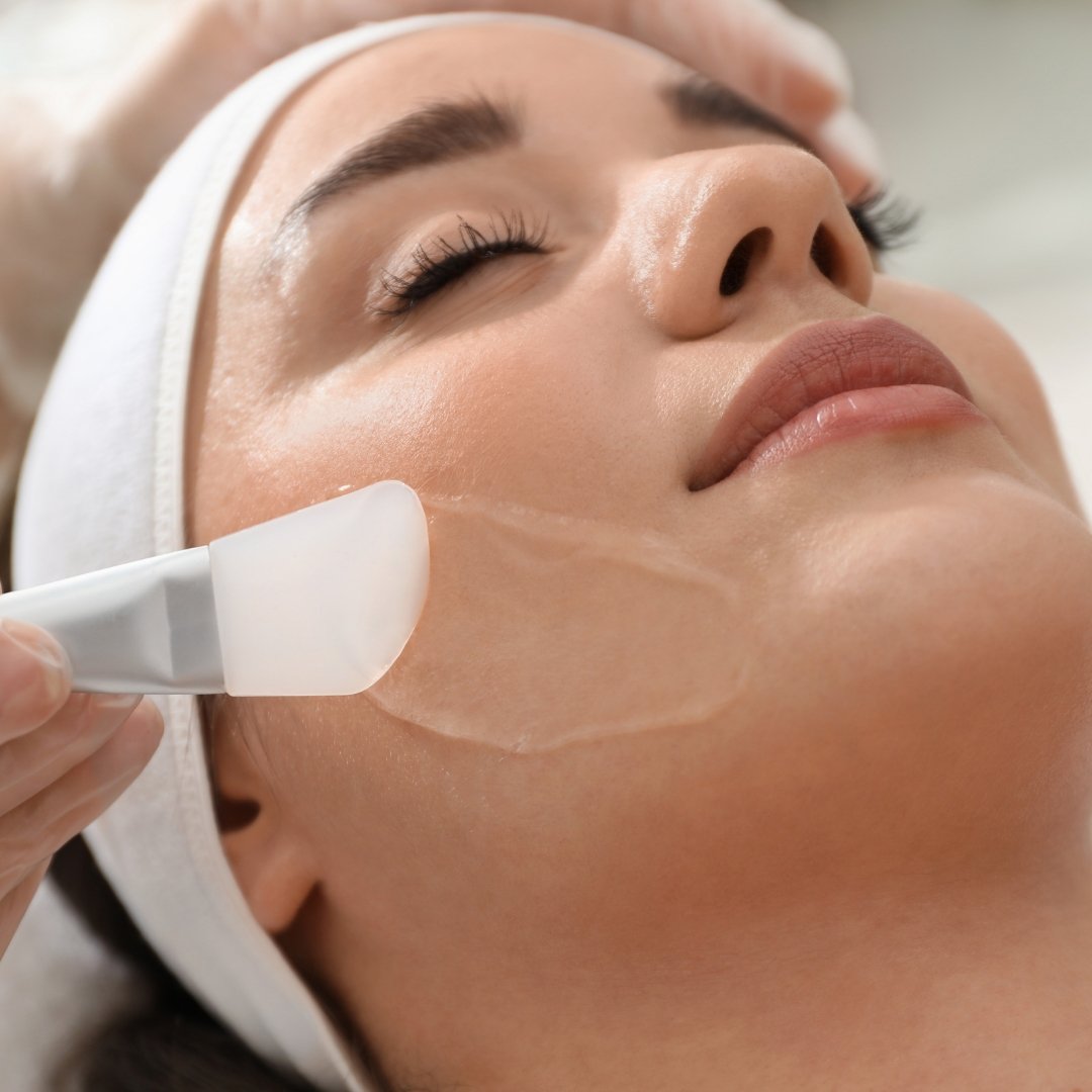 Chemical Peel