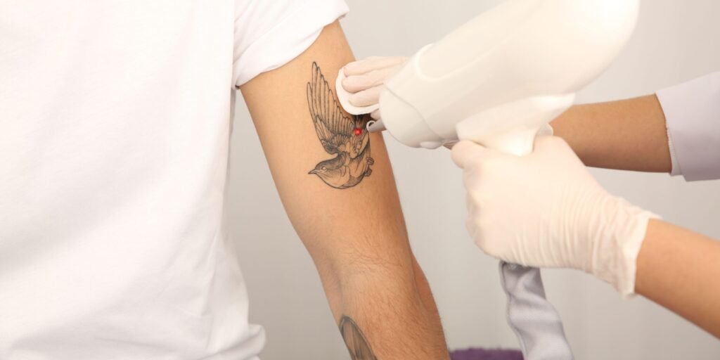 Laser Tattoo removal in Dubai
