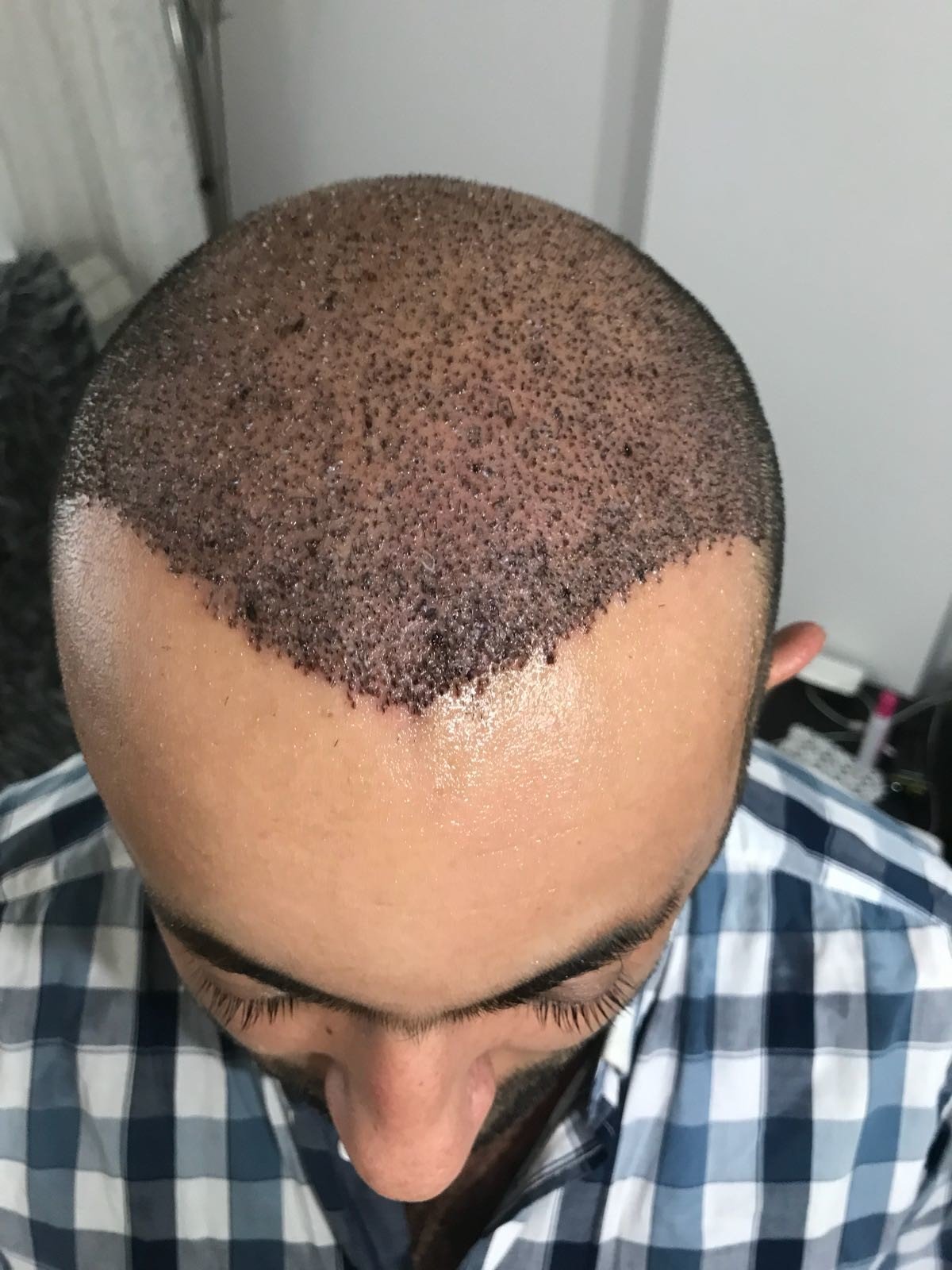 Hair Transplant