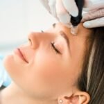 Microneedling