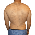 How Do I Choose the Best Surgeon for Brazilian Butt Lift Surgery in Houston?