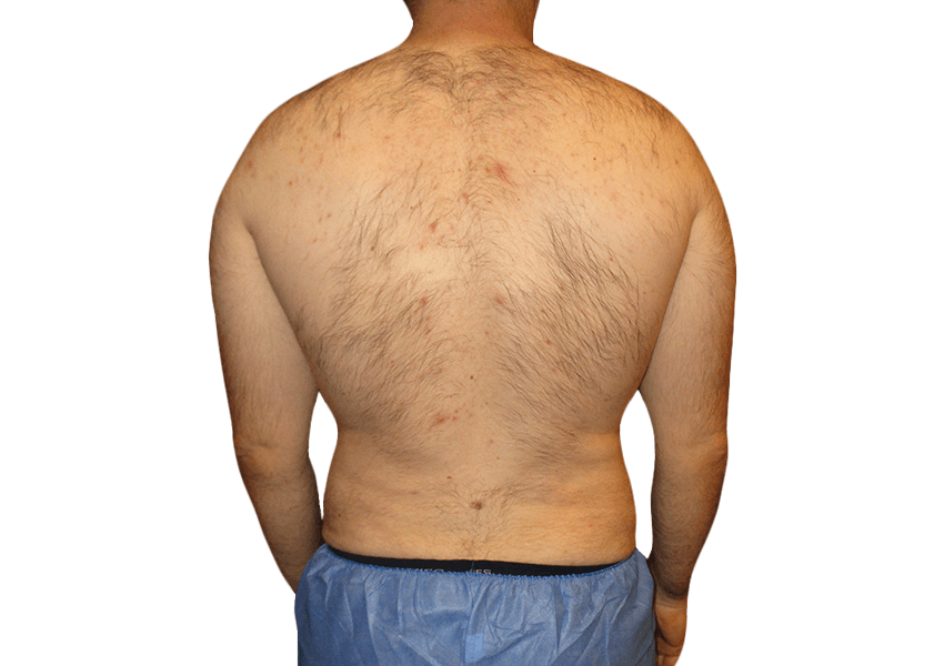 How Do I Choose the Best Surgeon for Brazilian Butt Lift Surgery in Houston?