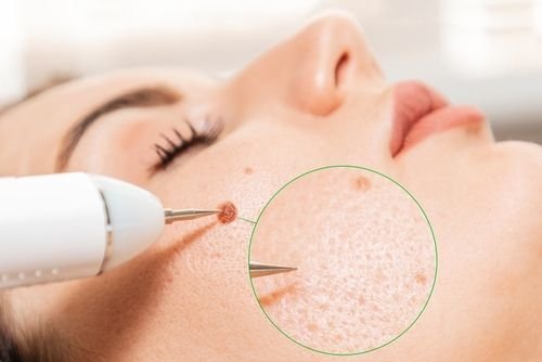 Treatment for Removing Birthmarks in Riyadh