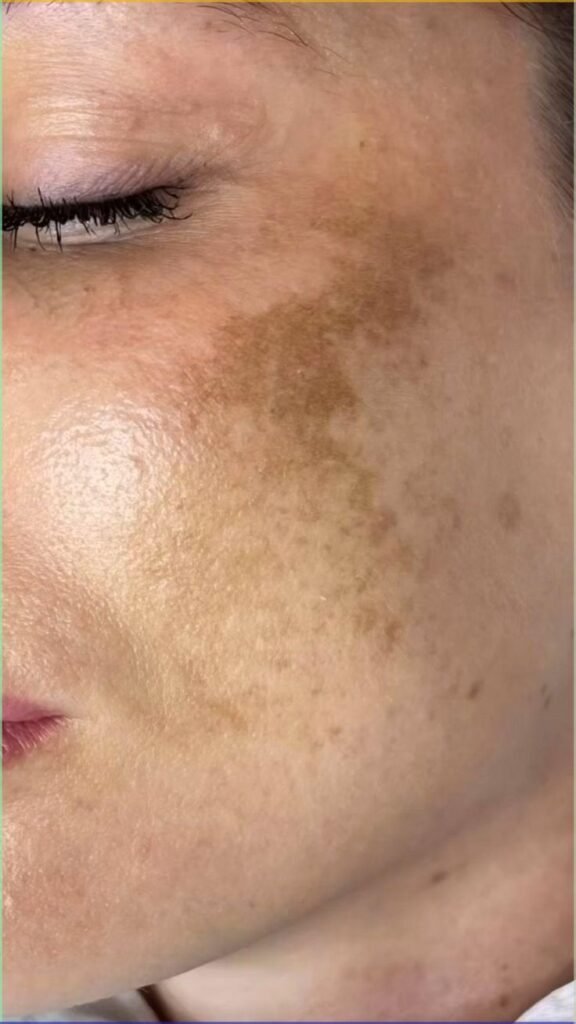 Treatment for Removing Birth Marks