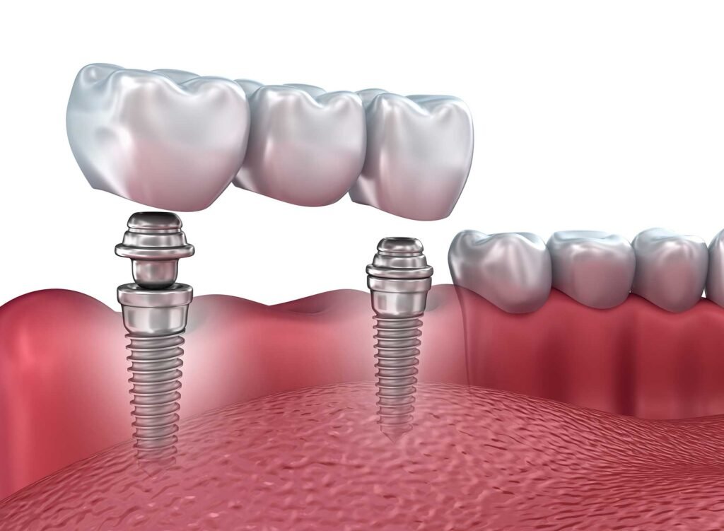dental implants new york ny