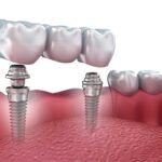 dental implants new york ny