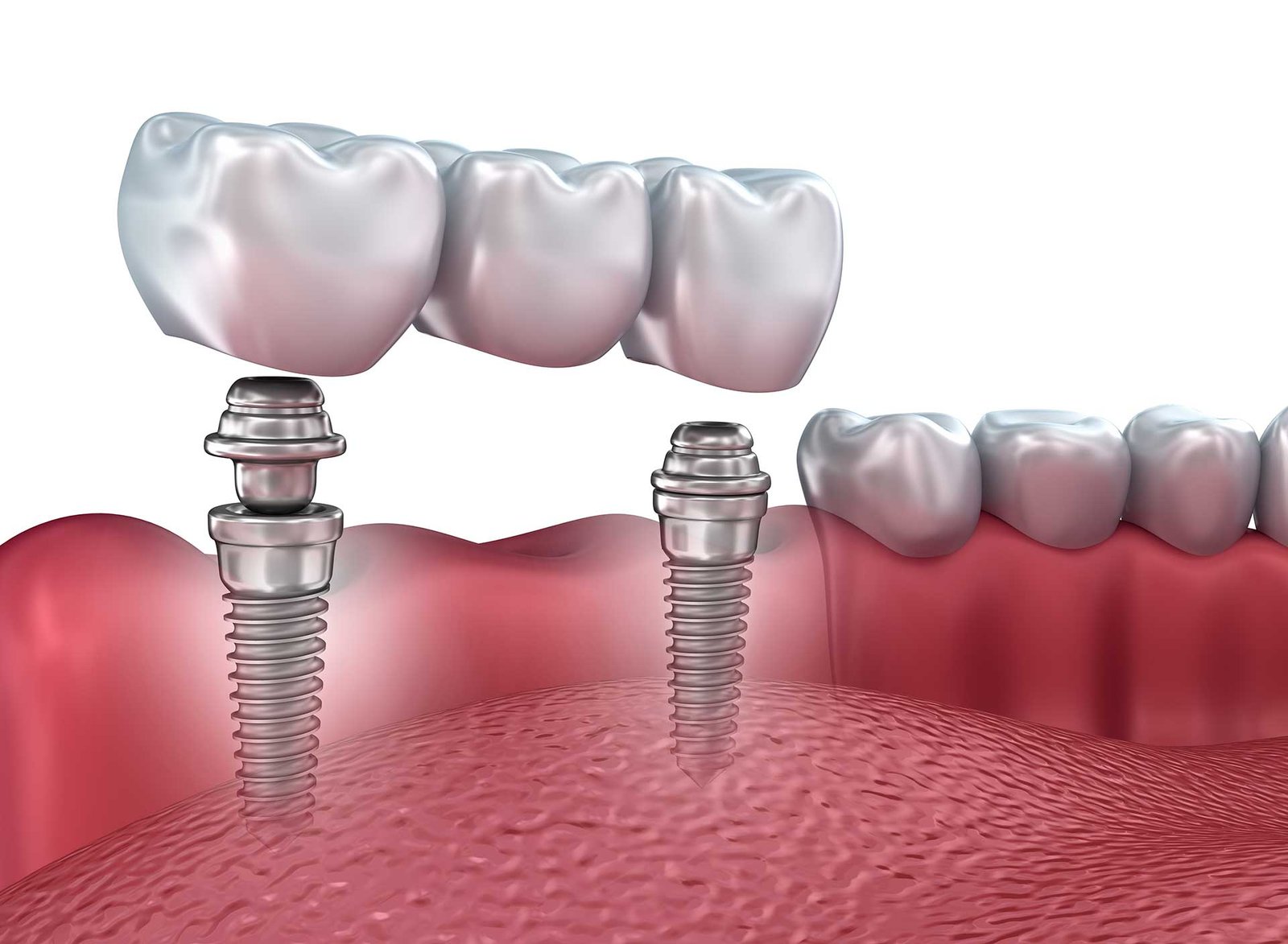 dental implants new york ny
