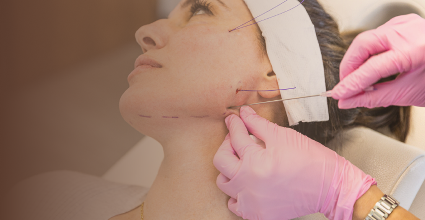 PDO Thread Lift: How It Works, What to Expect & Why It’s Gaining Popularity