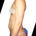 How Do You Choose the Best Clinic for Body Contouring in Houston?