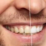 Common Stains And How Teeth Whitening In Arlington, TX, Solves Them