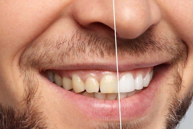 Common Stains And How Teeth Whitening In Arlington, TX, Solves Them