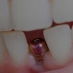 What Are the Risks or Complications Associated with Fixed Full Arch Dental Implants?